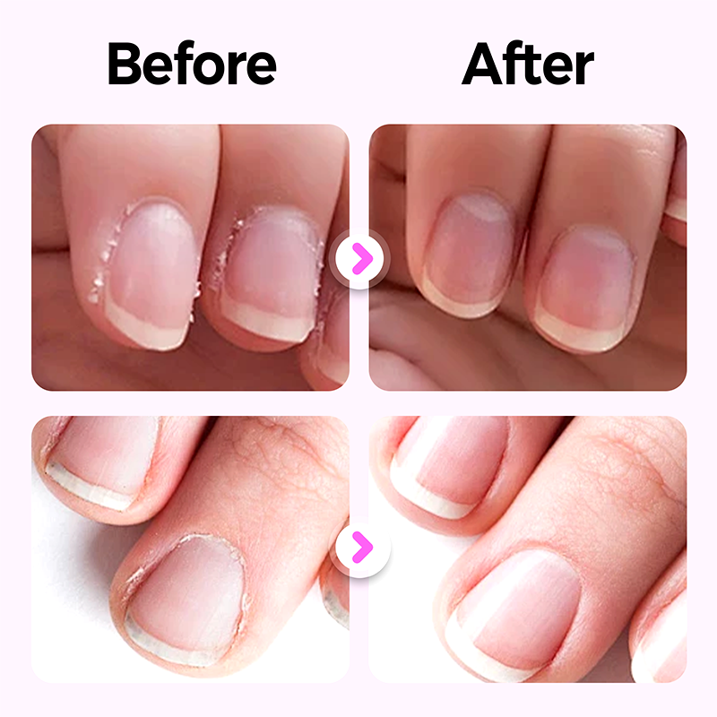 💜BUY 1 GET 1 FREE💜2026 New Upgraded 3-in-1 Nail Care Pen💅
